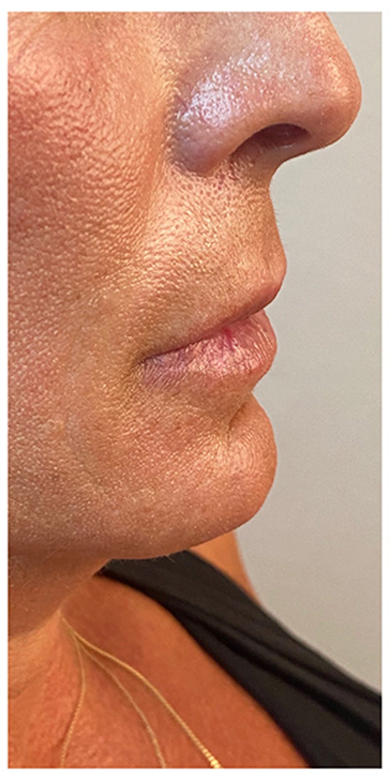 Lip Enhancement Before & After Gallery - Patient 133024185 - Image 9