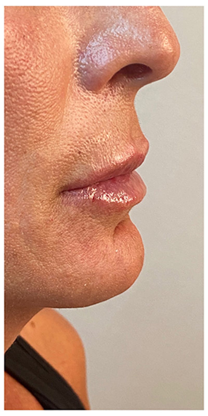 Lip Enhancement Before & After Gallery - Patient 133024185 - Image 10