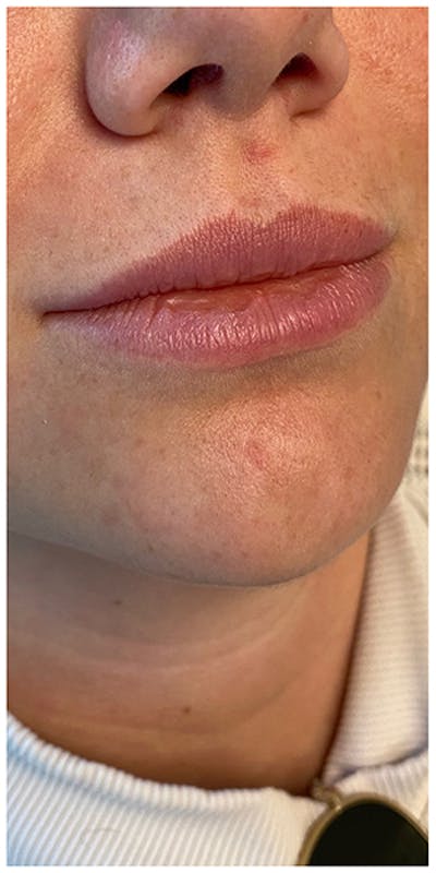 Lip Enhancement Before & After Gallery - Patient 133024189 - Image 1