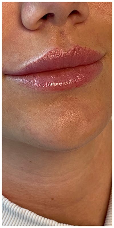 Lip Enhancement Before & After Gallery - Patient 133024189 - Image 2