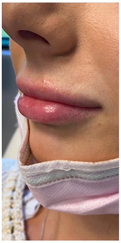 Lip Enhancement Before & After Gallery - Patient 133024193 - Image 1