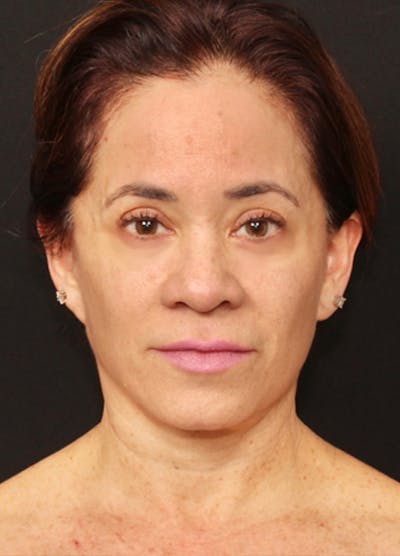 Facelift & Necklift Before & After Gallery - Patient 133024196 - Image 2