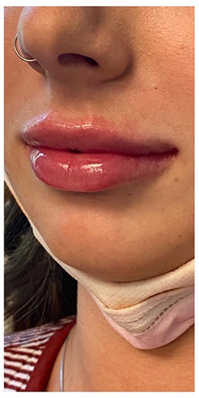 Lip Enhancement Before & After Gallery - Patient 133024193 - Image 2