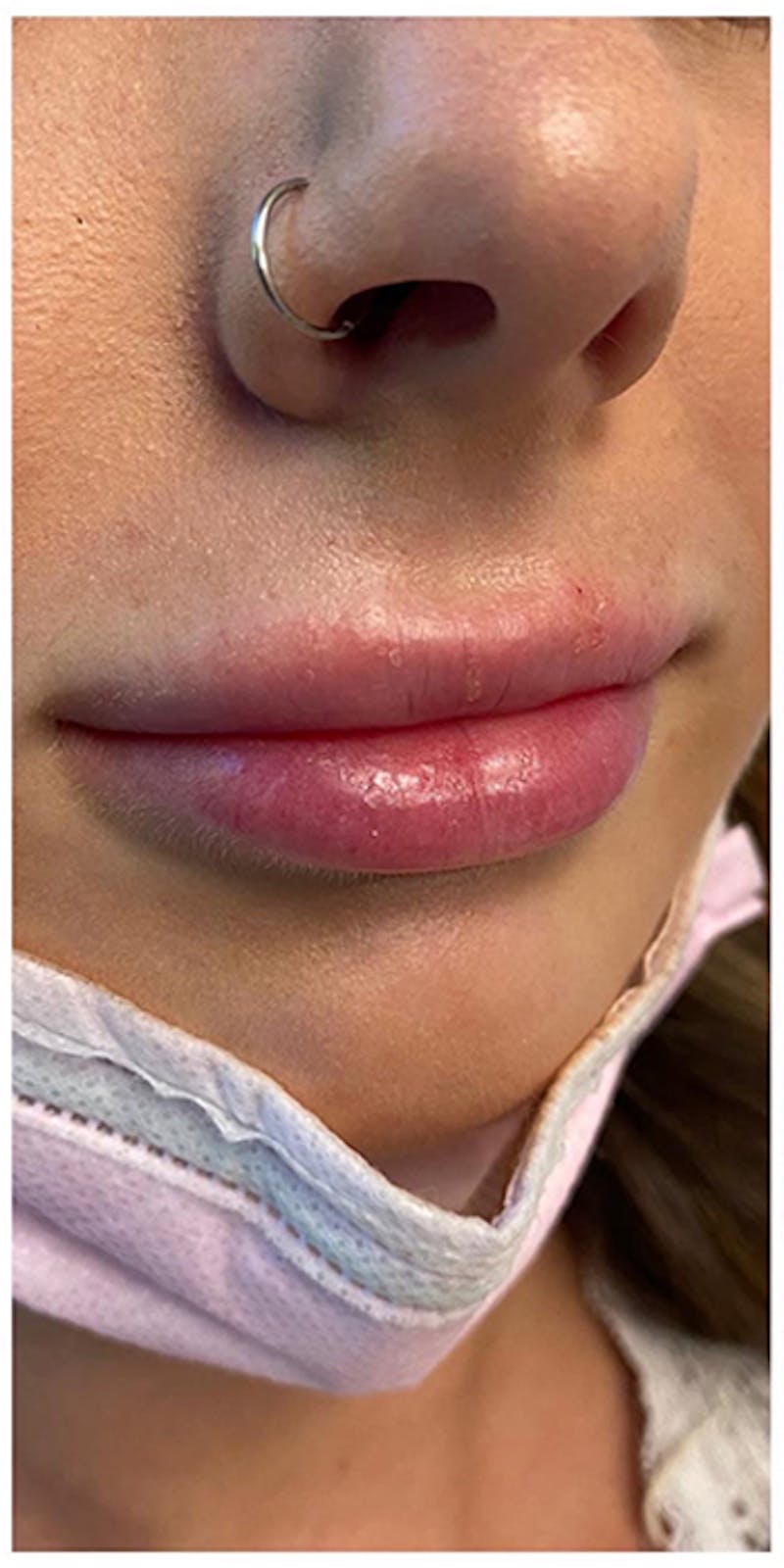 Lip Enhancement Before & After Gallery - Patient 133024193 - Image 3