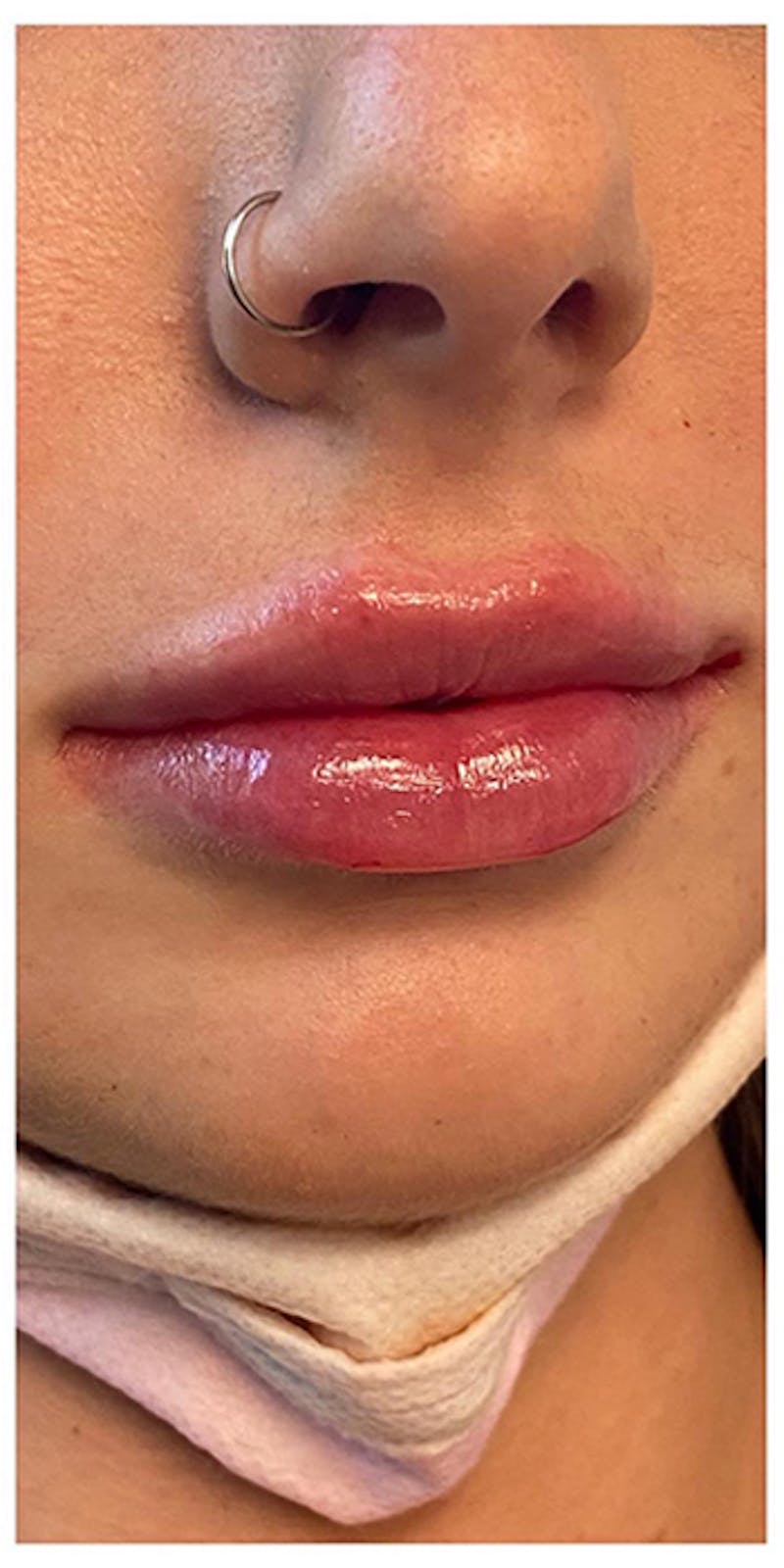 Lip Enhancement Before & After Gallery - Patient 133024193 - Image 4