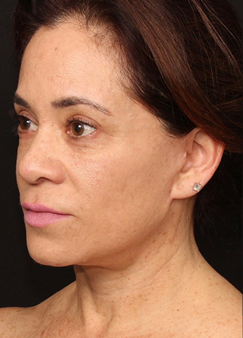 Facelift & Necklift Before & After Gallery - Patient 133024196 - Image 4