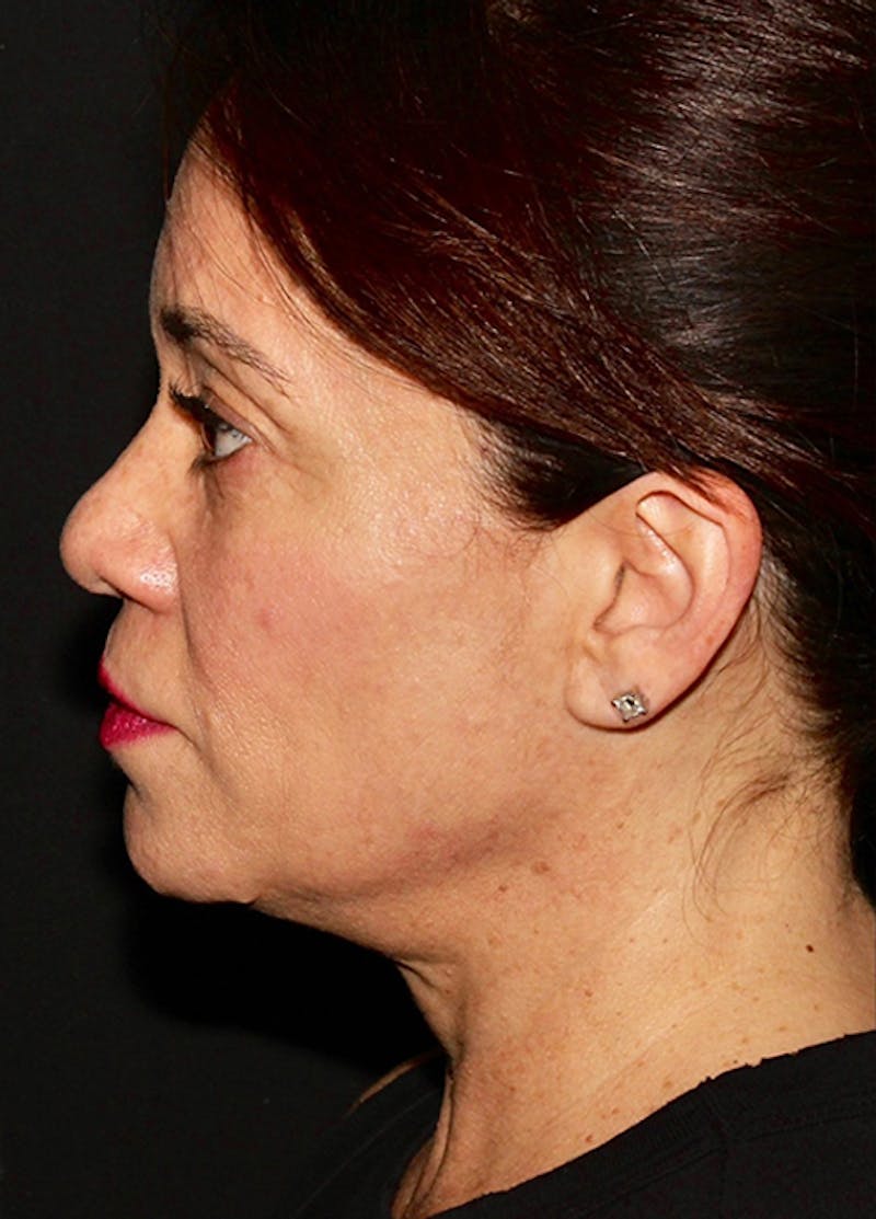 Facelift & Necklift Before & After Gallery - Patient 133024196 - Image 5
