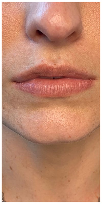 Lip Enhancement Before & After Gallery - Patient 133024194 - Image 1