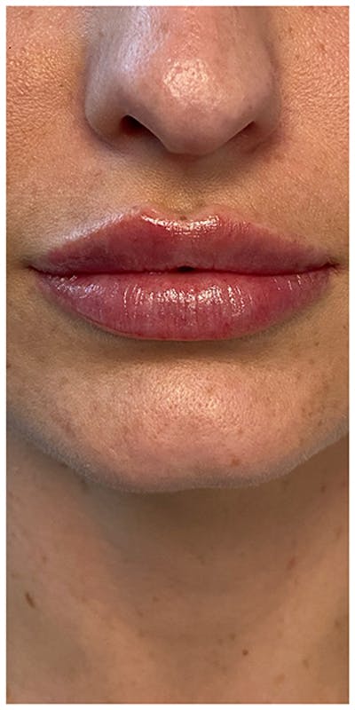 Lip Enhancement Before & After Gallery - Patient 133024194 - Image 2