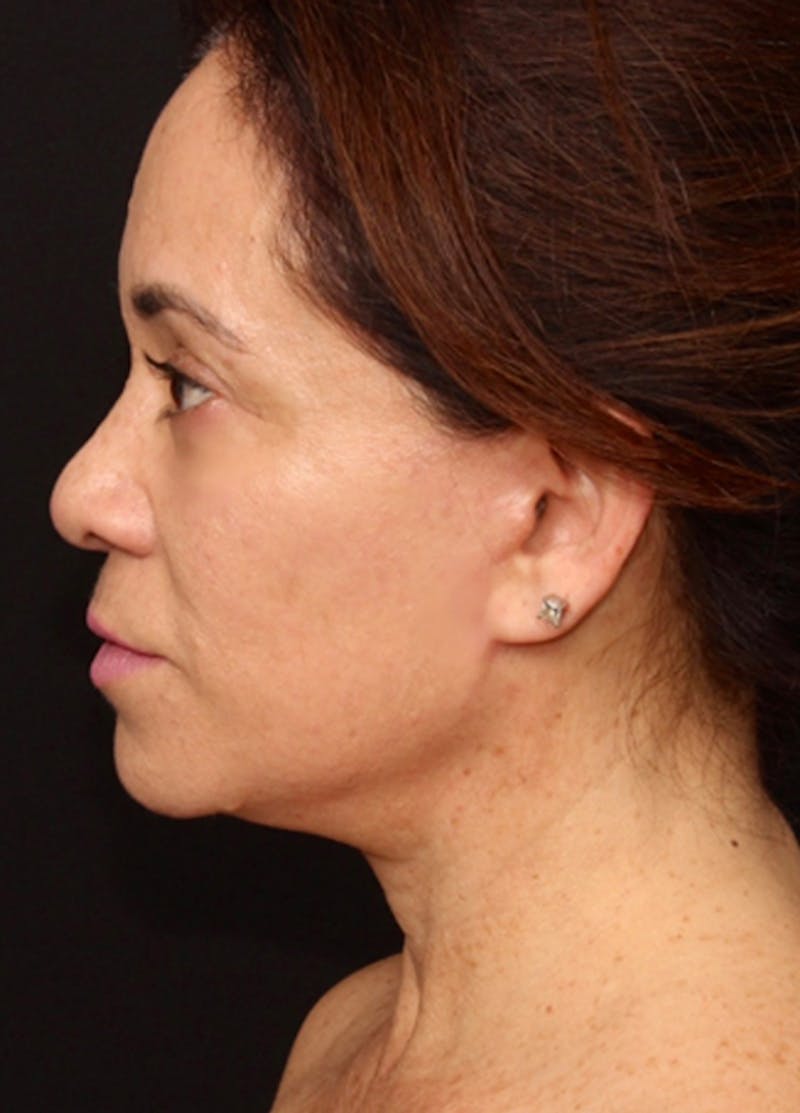 Facelift & Necklift Before & After Gallery - Patient 133024196 - Image 6