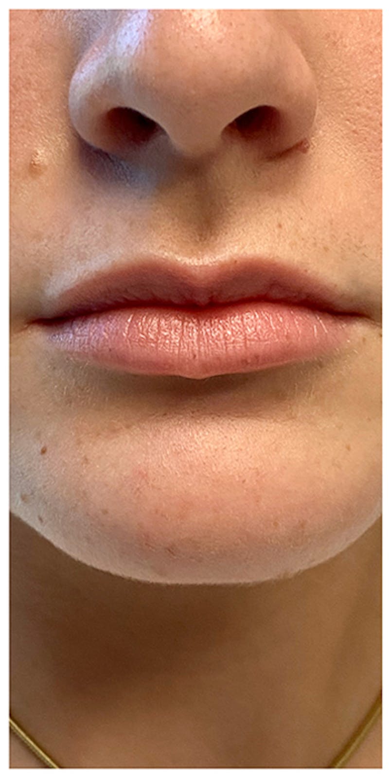 Lip Enhancement Before & After Gallery - Patient 133024202 - Image 1