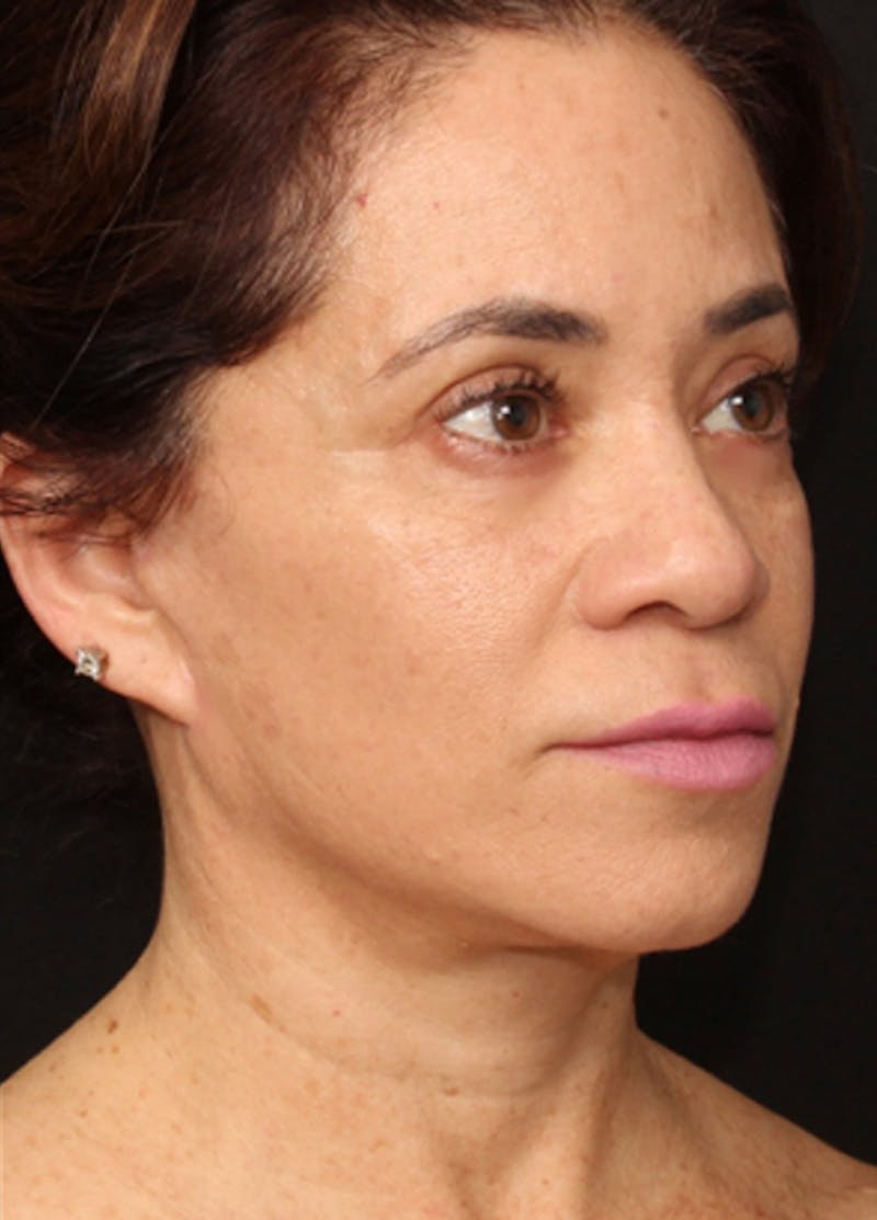 Facelift & Necklift Before & After Gallery - Patient 133024196 - Image 8