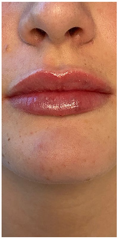 Lip Enhancement Before & After Gallery - Patient 133024202 - Image 2