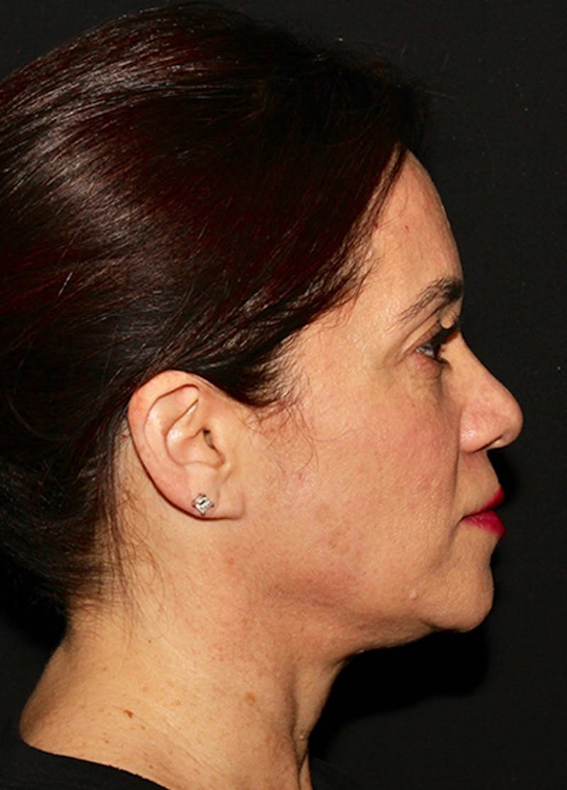 Facelift & Necklift Before & After Gallery - Patient 133024196 - Image 9
