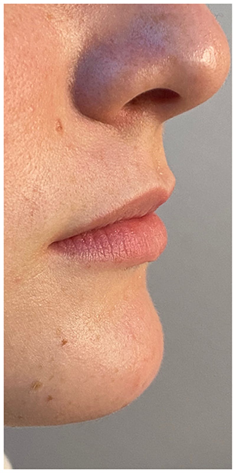 Lip Enhancement Before & After Gallery - Patient 133024202 - Image 3