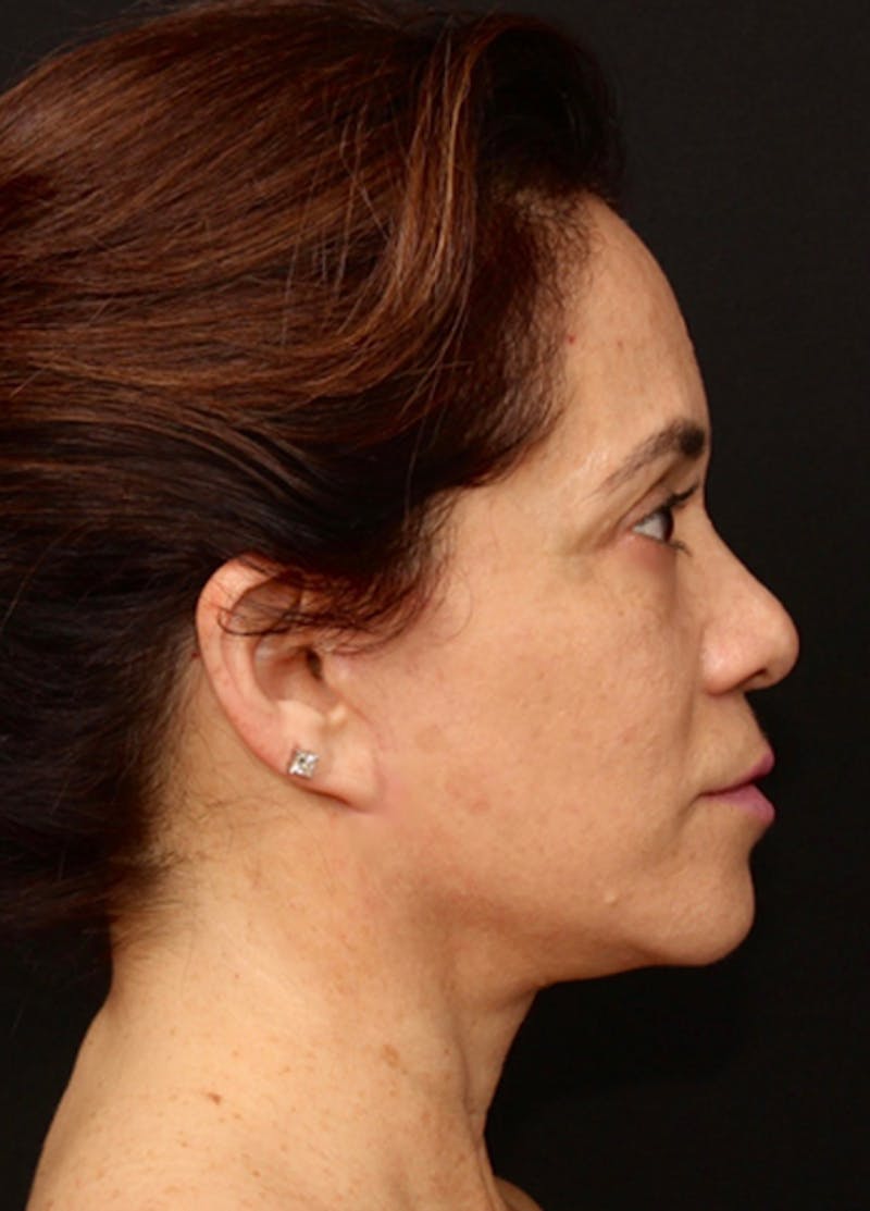 Facelift & Necklift Before & After Gallery - Patient 133024196 - Image 10