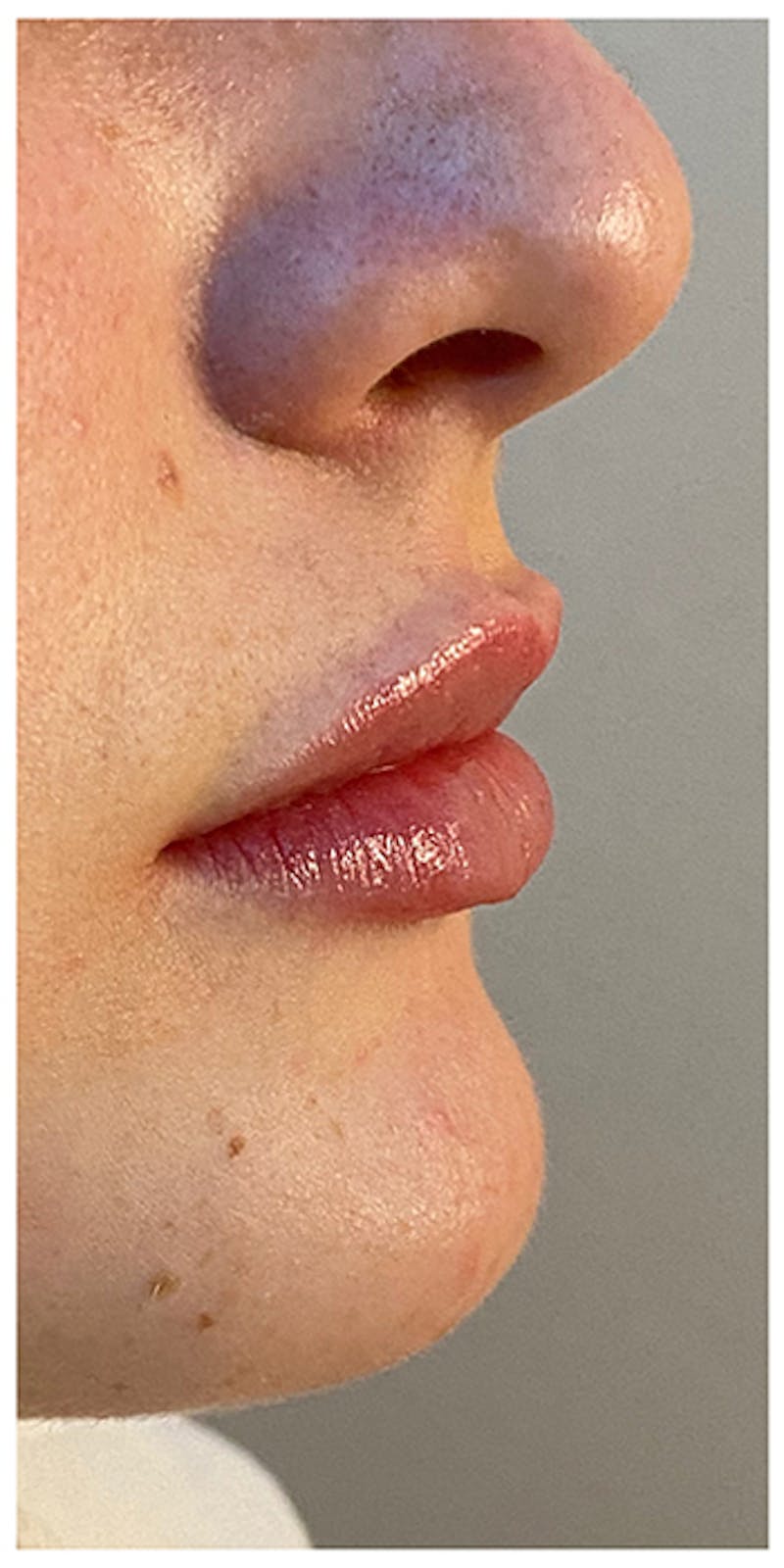Lip Enhancement Before & After Gallery - Patient 133024202 - Image 4