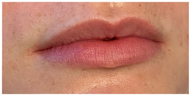 Lip Enhancement Before & After Gallery - Patient 133024202 - Image 5