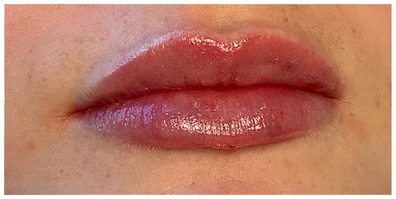 Lip Enhancement Before & After Gallery - Patient 133024202 - Image 6