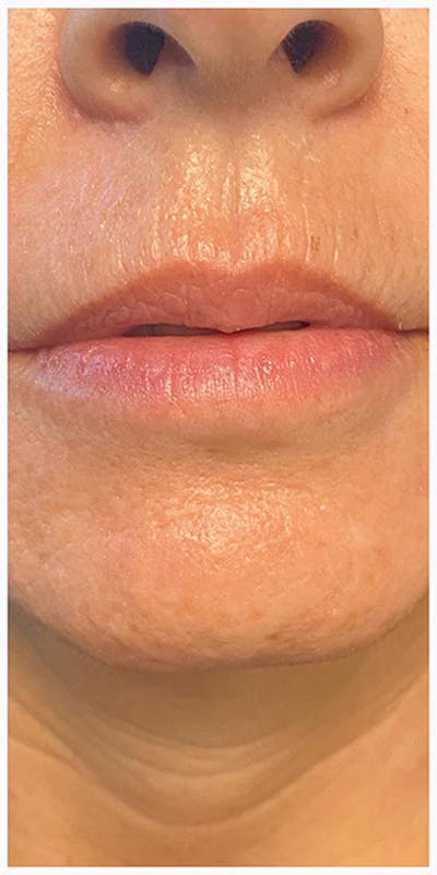 Lip Enhancement Before & After Gallery - Patient 133024207 - Image 1