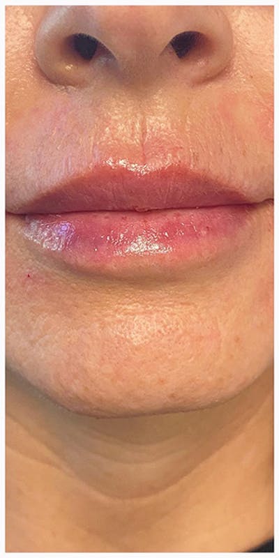 Lip Enhancement Before & After Gallery - Patient 133024207 - Image 2