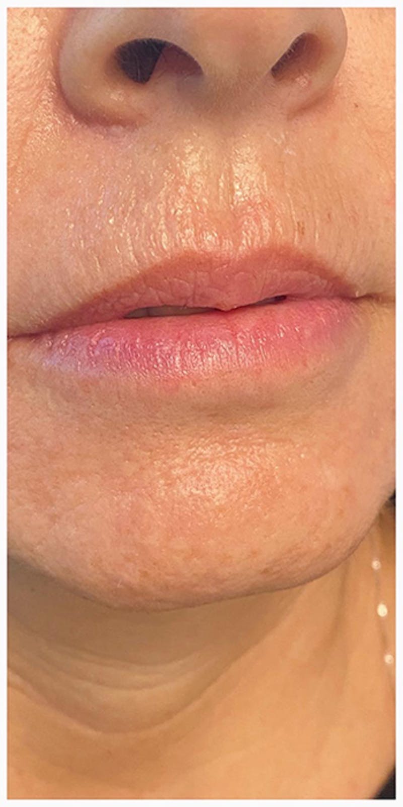 Lip Enhancement Before & After Gallery - Patient 133024207 - Image 3