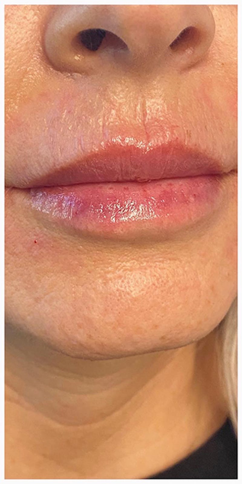 Lip Enhancement Before & After Gallery - Patient 133024207 - Image 4
