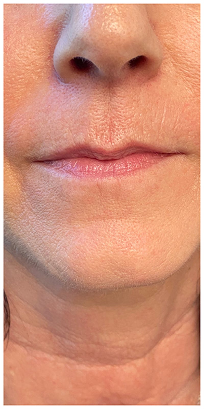Lip Enhancement Before & After Gallery - Patient 133024217 - Image 1