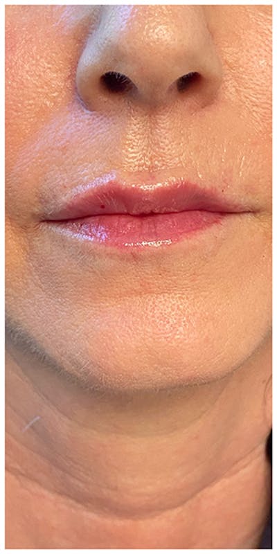 Lip Enhancement Before & After Gallery - Patient 133024217 - Image 2