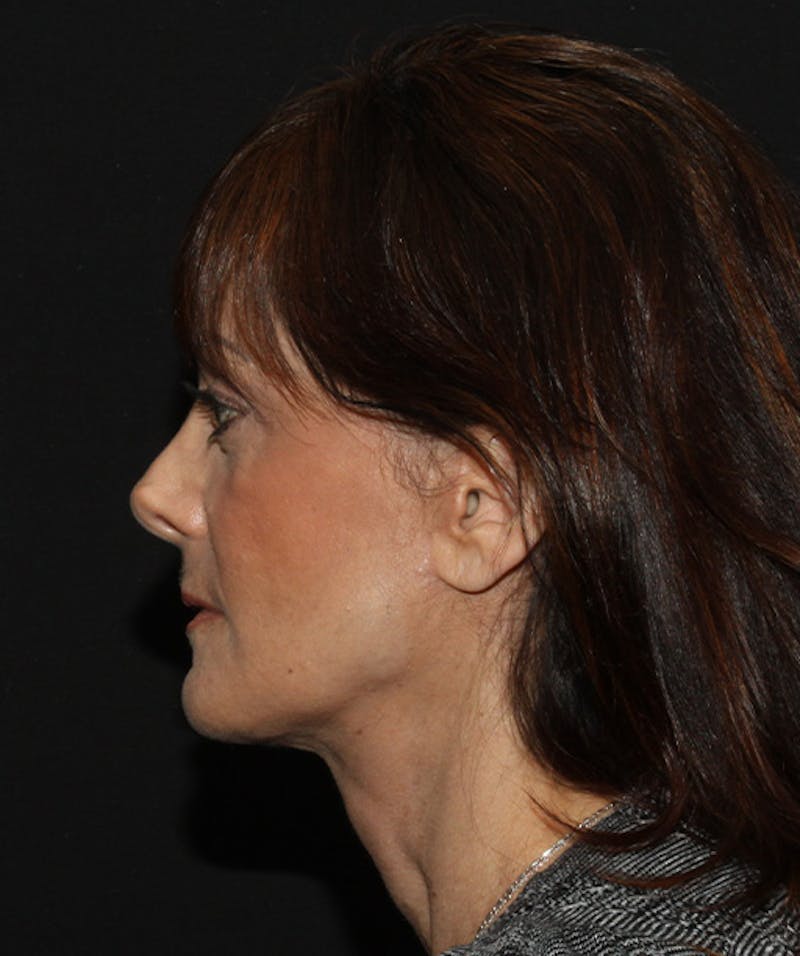 Facelift & Necklift Before & After Gallery - Patient 133024208 - Image 10