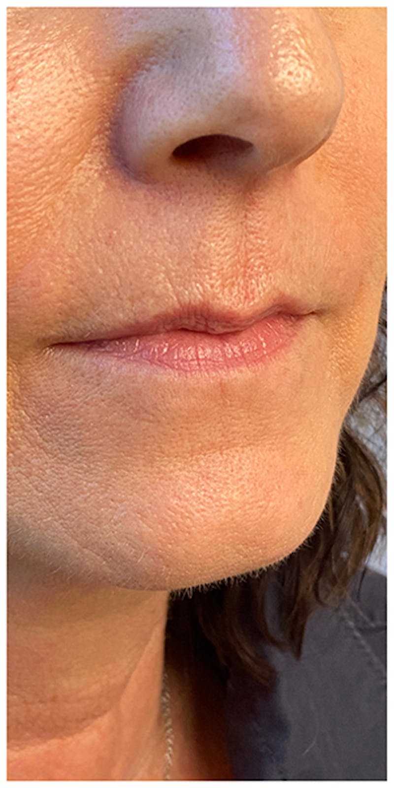 Lip Enhancement Before & After Gallery - Patient 133024217 - Image 3