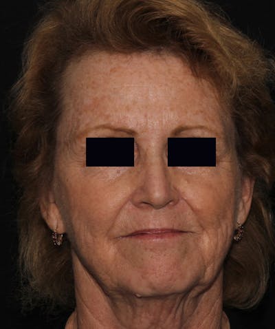 Facelift & Necklift Before & After Gallery - Patient 133024218 - Image 1