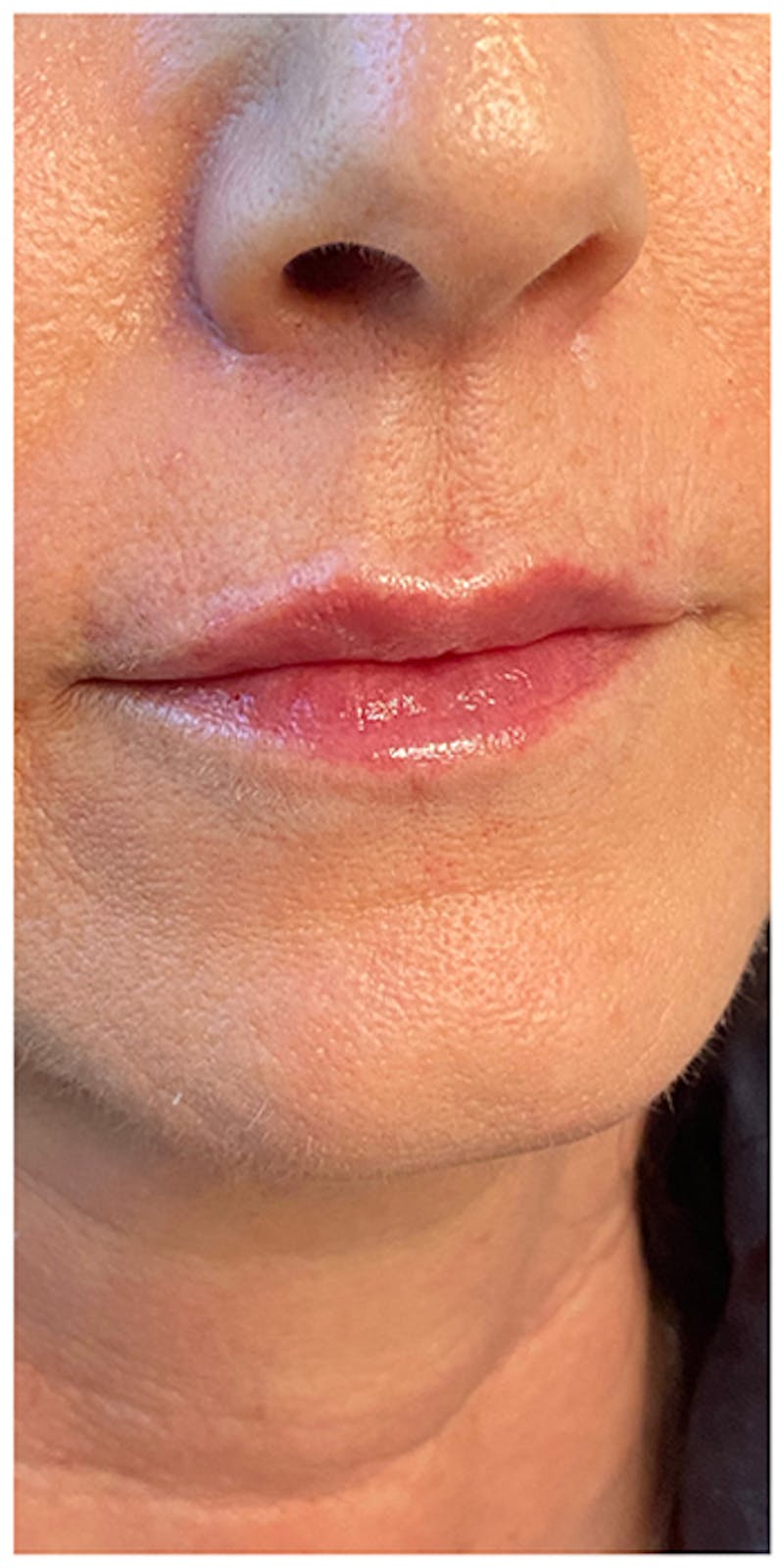 Lip Enhancement Before & After Gallery - Patient 133024217 - Image 4