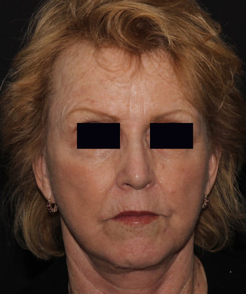 Facelift & Necklift Before & After Gallery - Patient 133024218 - Image 2