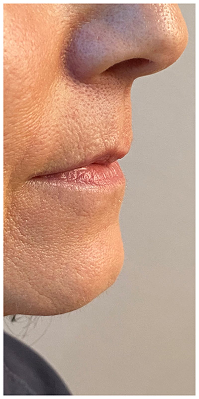 Lip Enhancement Before & After Gallery - Patient 133024217 - Image 5