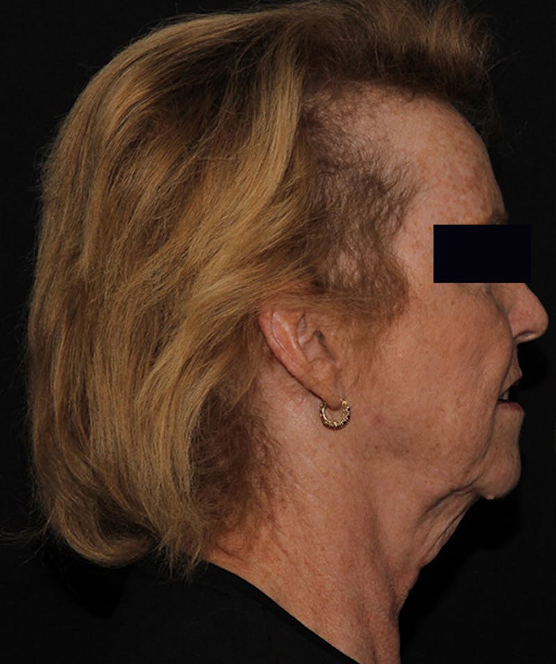 Facelift & Necklift Before & After Gallery - Patient 133024218 - Image 3