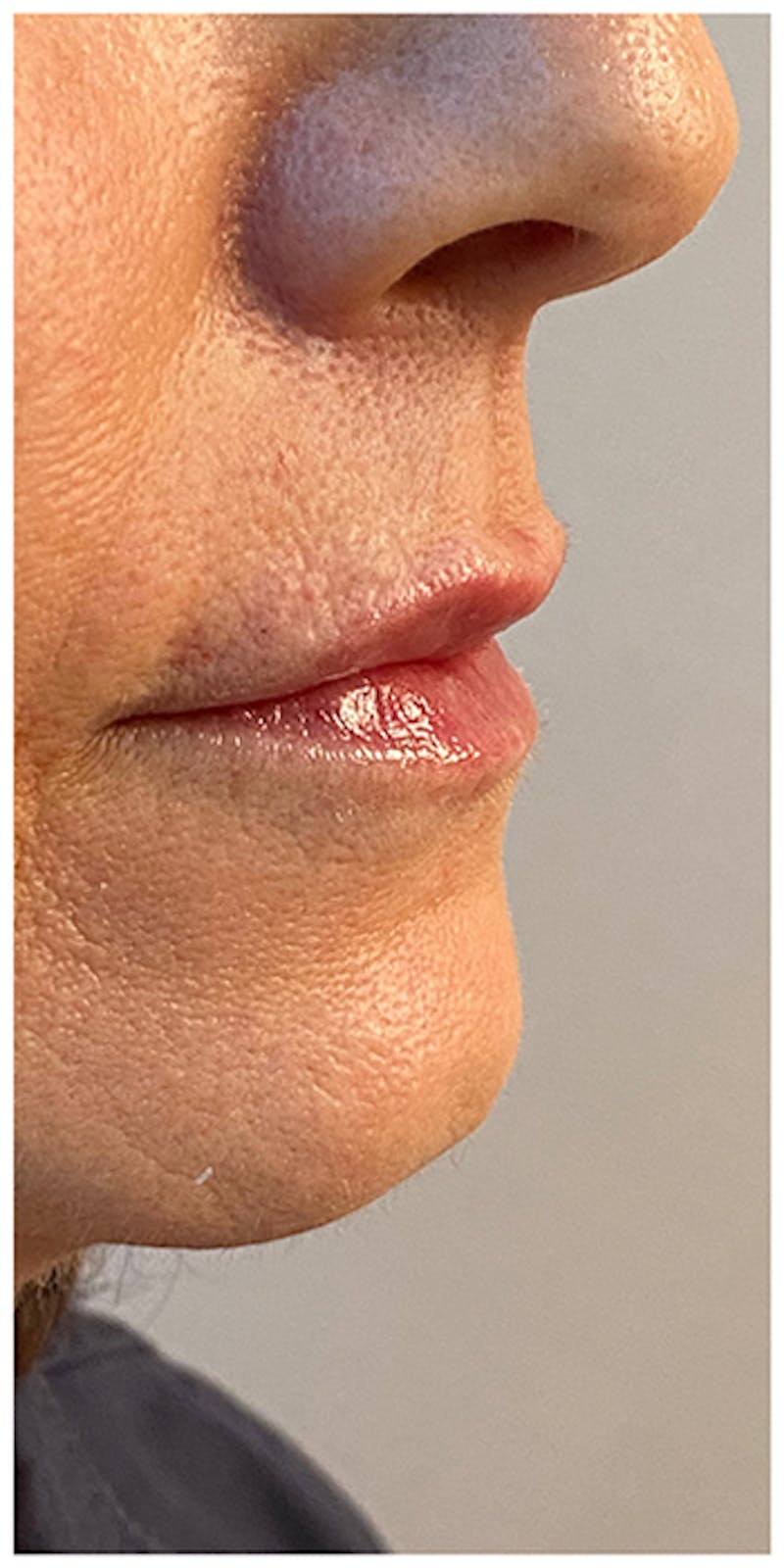 Lip Enhancement Before & After Gallery - Patient 133024217 - Image 6