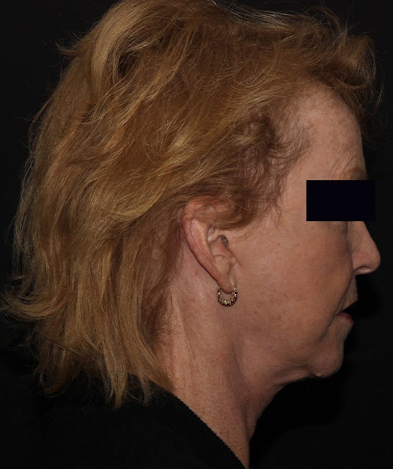 Facelift & Necklift Before & After Gallery - Patient 133024218 - Image 4