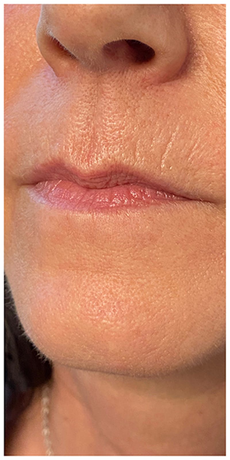 Lip Enhancement Before & After Gallery - Patient 133024217 - Image 7