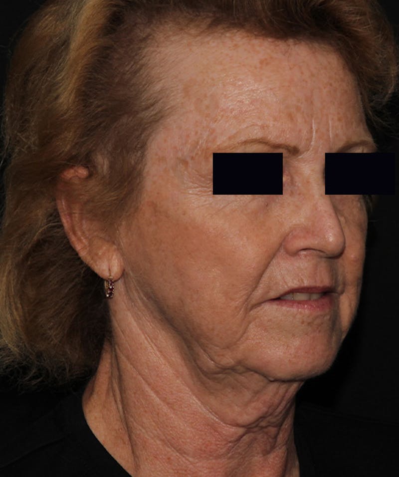 Facelift & Necklift Before & After Gallery - Patient 133024218 - Image 5