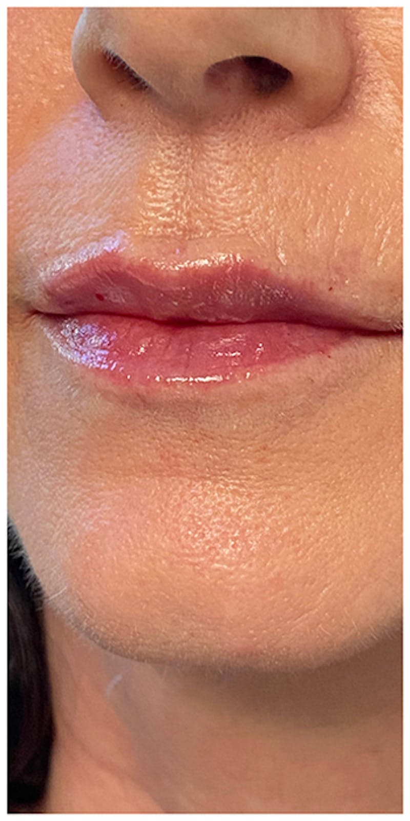 Lip Enhancement Before & After Gallery - Patient 133024217 - Image 8
