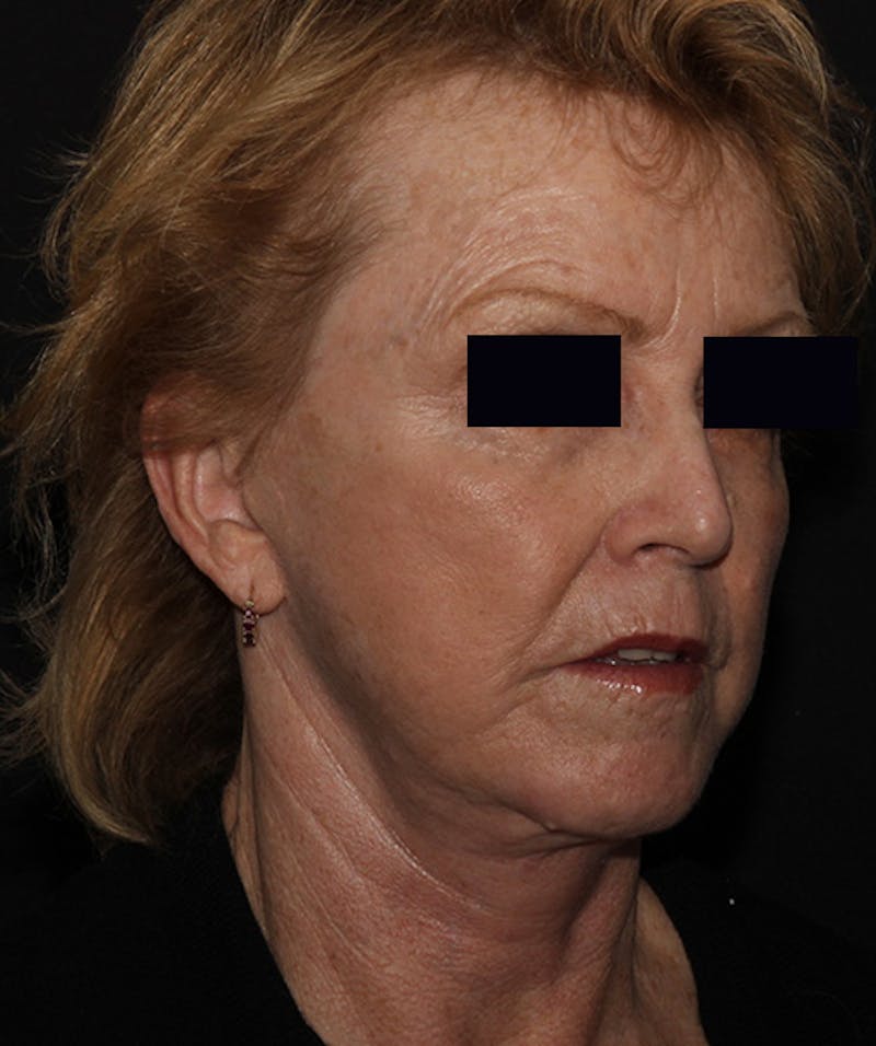 Facelift & Necklift Before & After Gallery - Patient 133024218 - Image 6