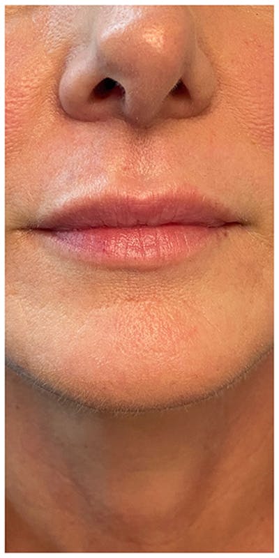 Lip Enhancement Before & After Gallery - Patient 133024219 - Image 1