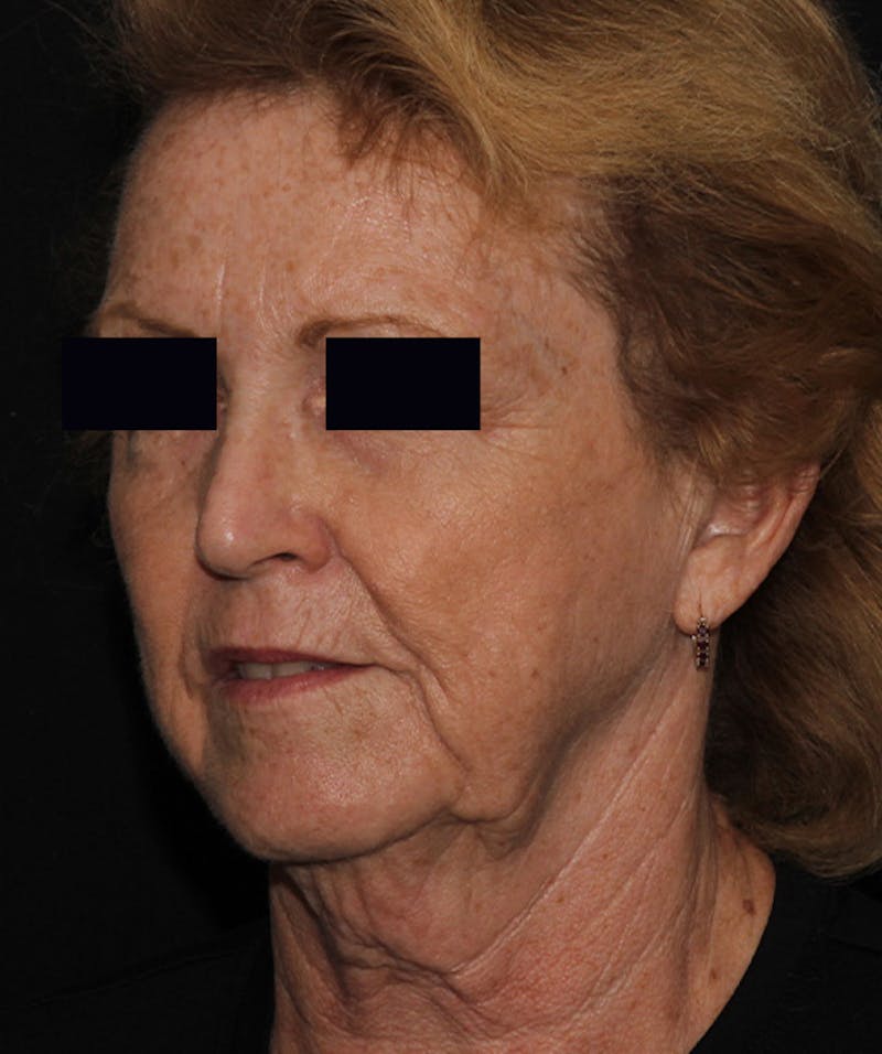 Facelift & Necklift Before & After Gallery - Patient 133024218 - Image 7