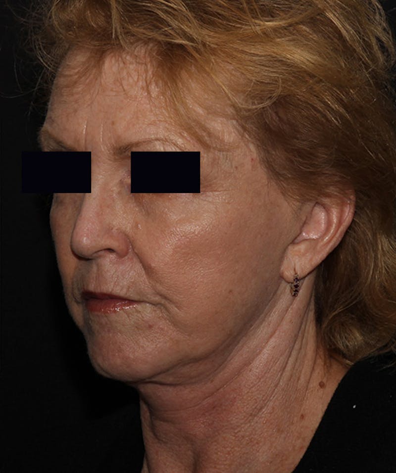 Facelift & Necklift Before & After Gallery - Patient 133024218 - Image 8