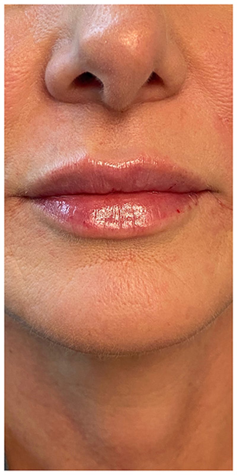 Lip Enhancement Before & After Gallery - Patient 133024219 - Image 2