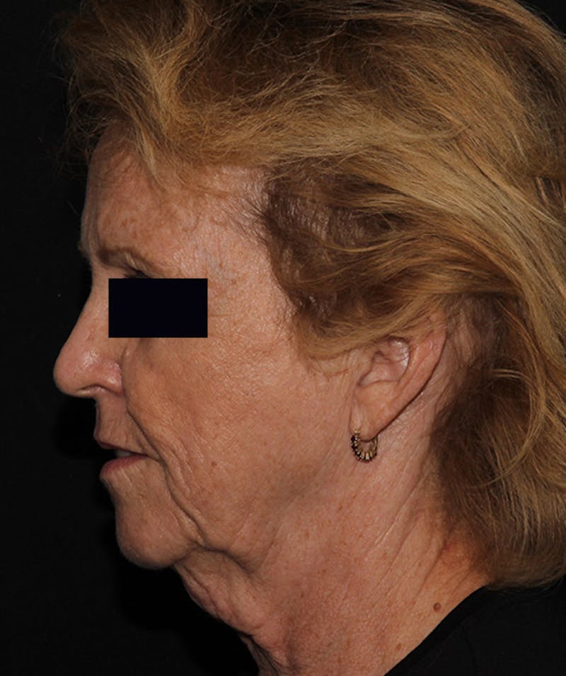 Facelift & Necklift Before & After Gallery - Patient 133024218 - Image 9