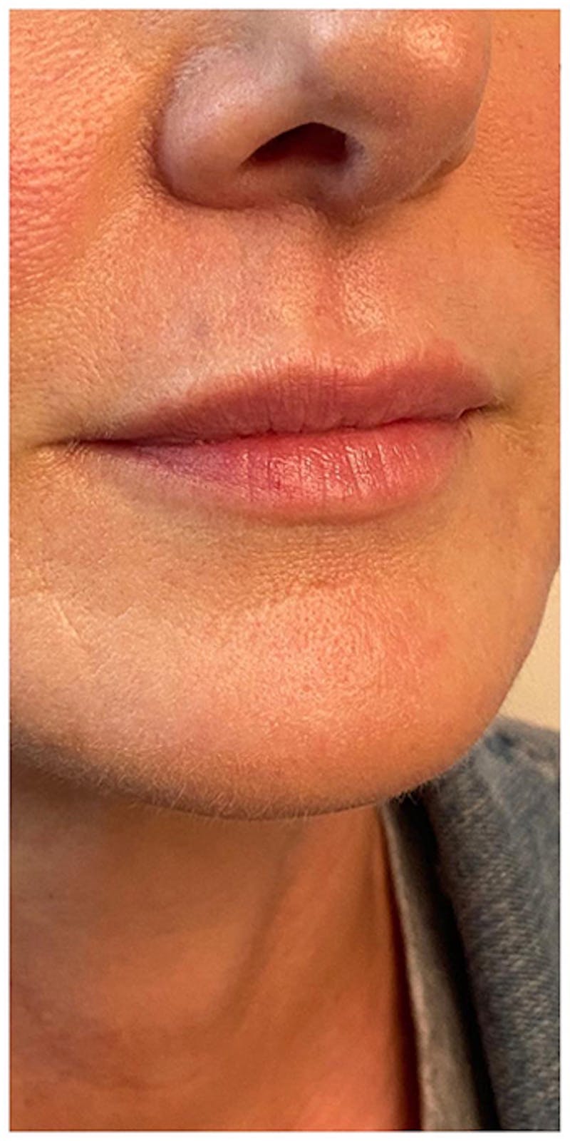 Lip Enhancement Before & After Gallery - Patient 133024219 - Image 3