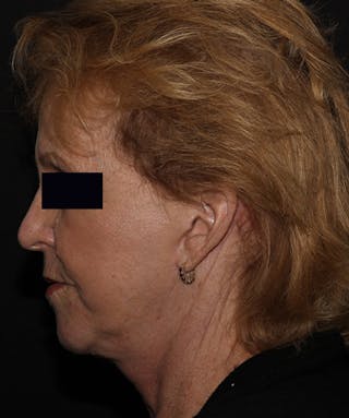 Facelift & Necklift Before & After Gallery - Patient 133024218 - Image 10
