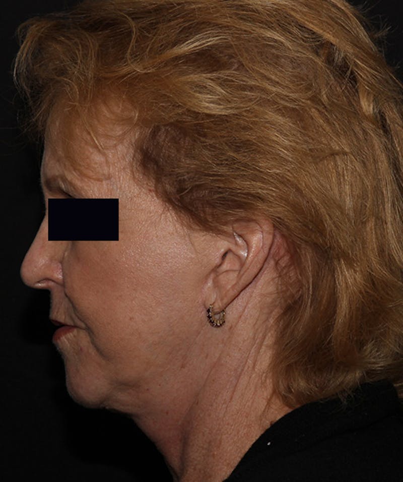 Facelift & Necklift Before & After Gallery - Patient 133024218 - Image 10
